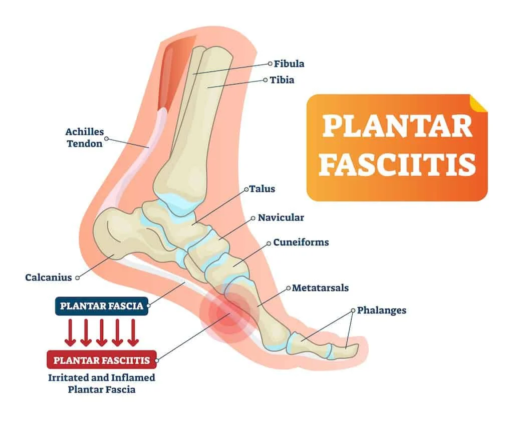 plantar fasciitis